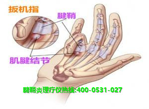 龙马腱鞘炎理疗仪